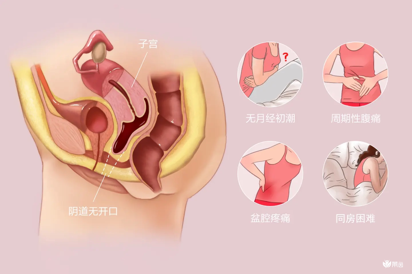 幼稚子宫怀孕几率并非为零，掌握3种方法轻松助孕！