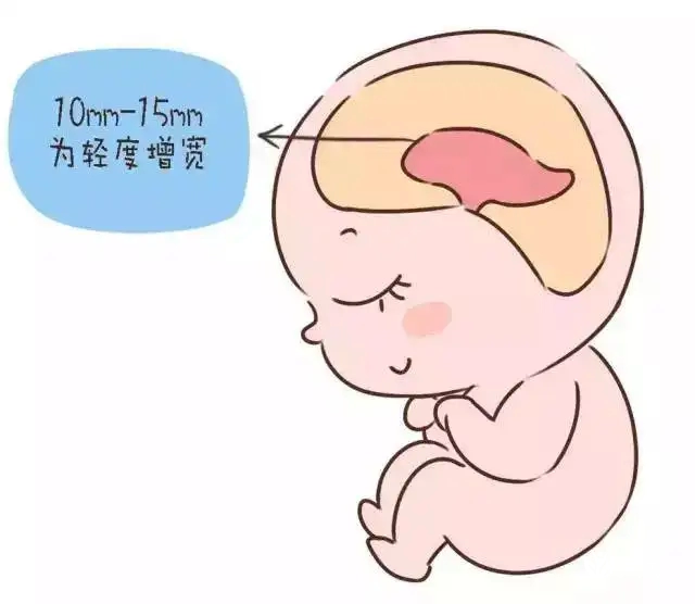 准妈妈发现胎儿侧脑室增宽！不能吃什么、做什么注意事项科普